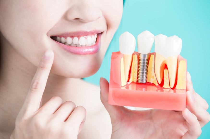 Replacing Missing Teeth – What Are Your Options and Which Dentist Should You Choose?
